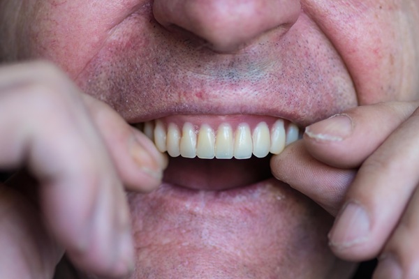 Overdentures Supported By Dental Implants