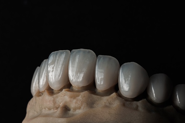 Implant Crowns Vs  Traditional Crowns: Key Differences Explained